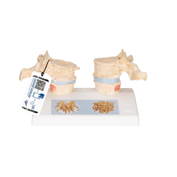 Osteoporosis Didactic Model - 3B Smart Anatomy