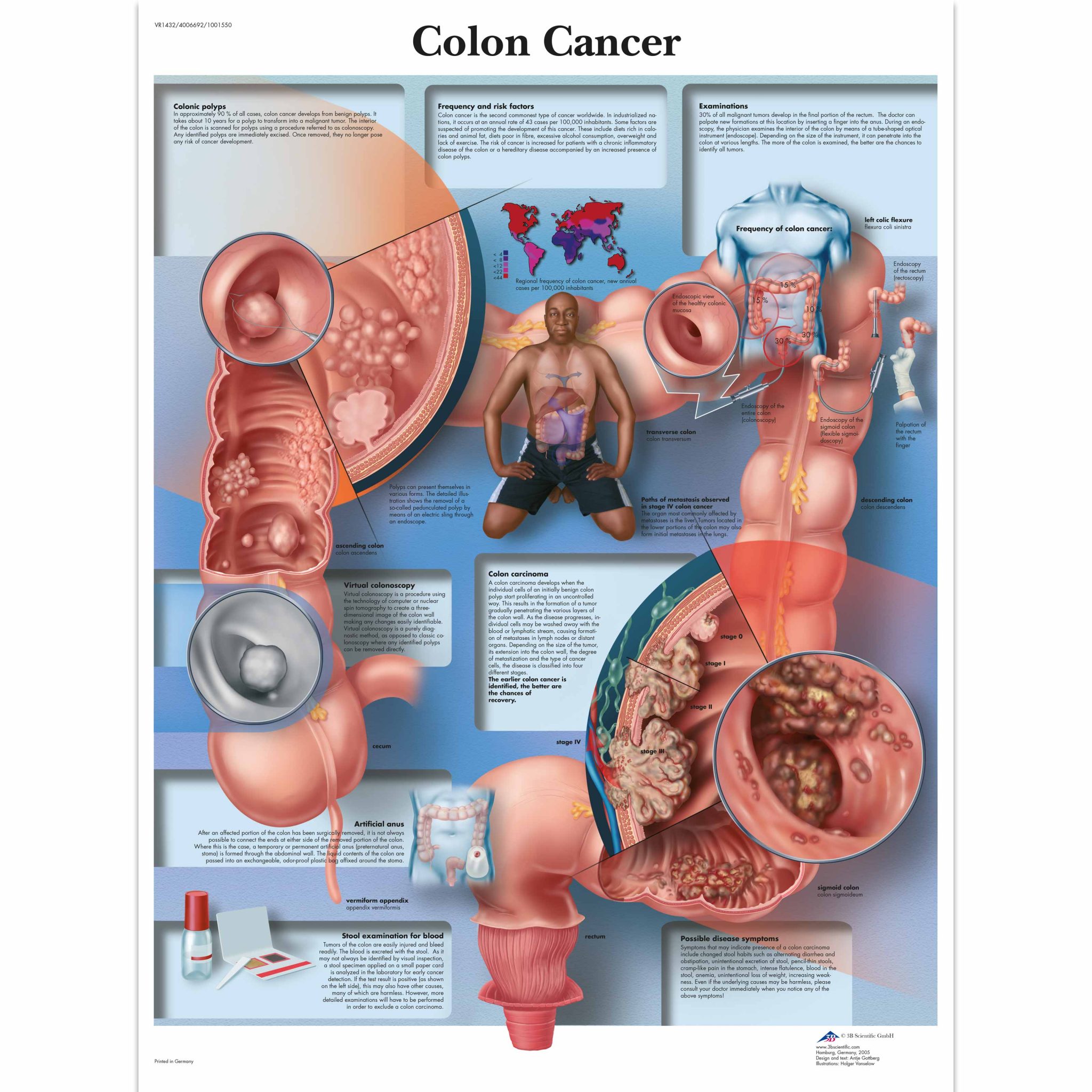 Colon Cancer Chart - Modiezham Sdn Bhd